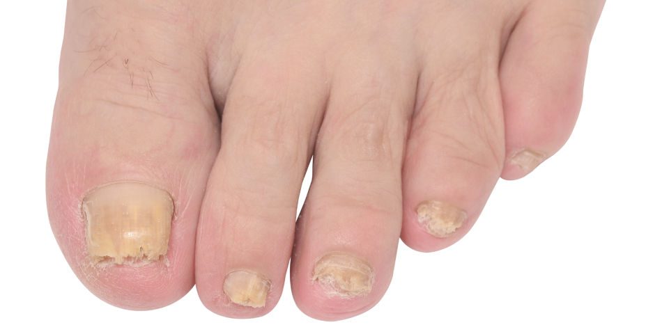Behandeling van voetschimmel en schimmelnagels
